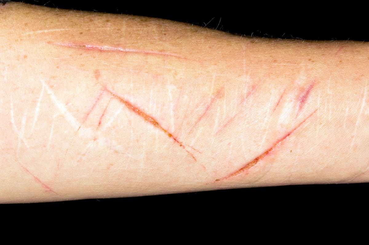 scars from cutting