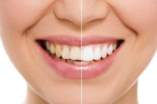Beautiful Teeth with the Right Care and Cosmetic Dentistry - teeth whitening