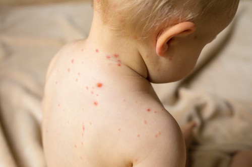 chickenpox childhood diseases